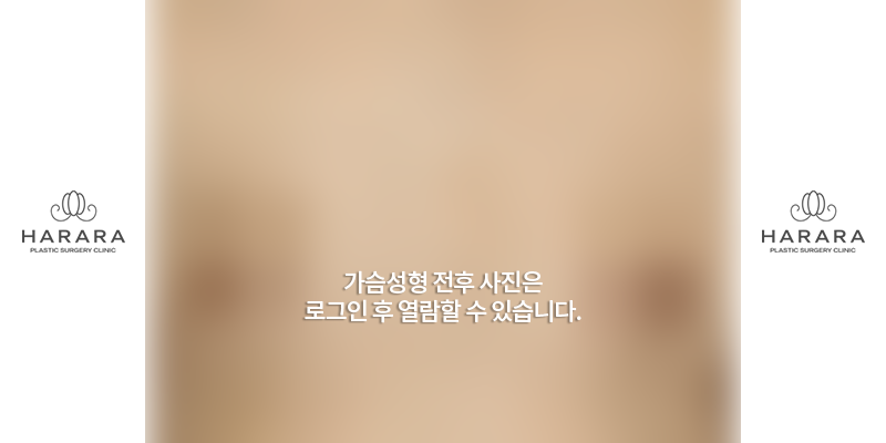 가슴확대수술 (7개월경과) 전