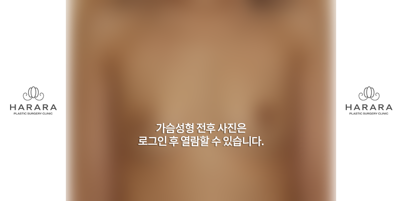 가슴확대수술 (6개월경과) 전
