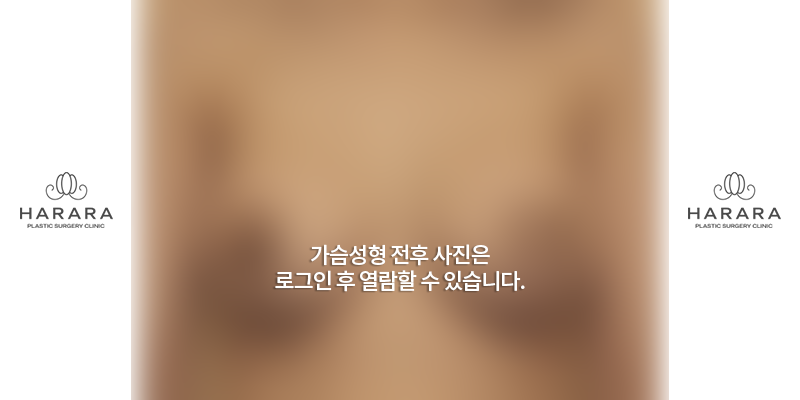 가슴확대수술 (6개월경과) 후