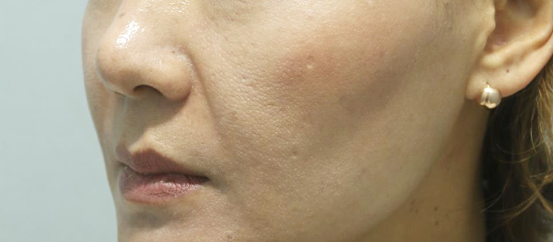 팔자필러 전