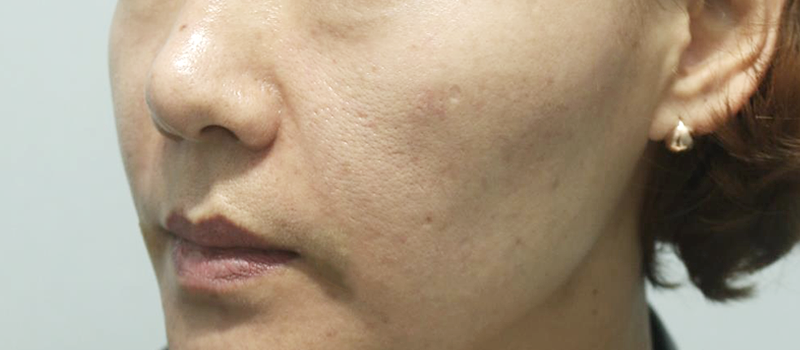 팔자필러 후