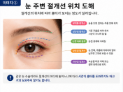 눈성형에서 흉터 위치와 시간의 관계