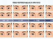 눈밑 수술 회복 — 지방 재배치량 관점에서 놓치기 쉬운 것